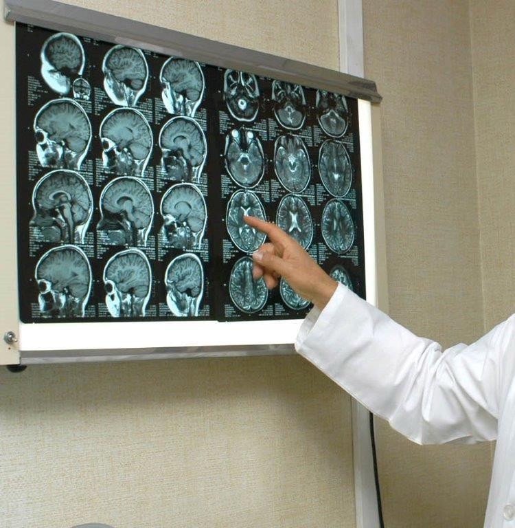 Orienta IMSS Yucat&aacute;n sobre epilepsia y servicios que otorga ante esta afecci&oacute;n