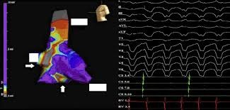 IMSS Bienestar incorpora sistema de mapeo electroanat&oacute;mico para el tratamiento de arritmias en el HRAEPY