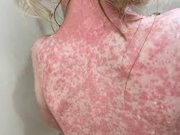 Registra Yucat&aacute;n 18 casos de sarampi&oacute;n