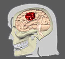 Sexta causa de muerte en México la enfermedad vascular cerebral Sexta causa de muerte en México la enfermedad vascular cerebral