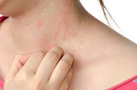 Cuidado con las alergias e intoxicaciones este fin de año Cuidado con las alergias e intoxicaciones este fin de año
