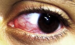 Síndrome del ojo seco muy común y poco diagnosticado Síndrome del ojo seco muy común y poco diagnosticado
