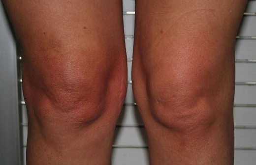 Sobrepeso y obesidad afectan de manera importante a las rodillas Sobrepeso y obesidad afectan de manera importante a las rodillas