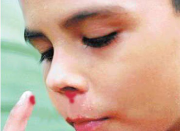 Calculan que hay 300 personas con hemofilia en Yucatán Calculan que hay 300 personas con hemofilia en Yucatán