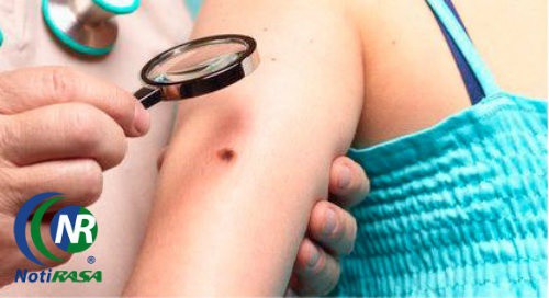 Cuidado con el cáncer de piel Cuidado con el cáncer de piel