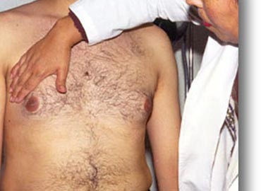 En Yucatán se presentan de 1 a 3 de casos de cáncer de mama en hombres al año En Yucatán se presentan de 1 a 3 de casos de cáncer de mama en hombres al año