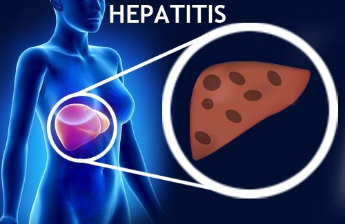 IMSS Yucatán informa a la población medidas preventivas para evitar contraer hepatitis IMSS Yucatán informa a la población medidas preventivas para evitar contraer hepatitis