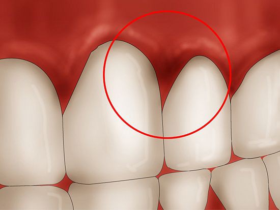Gingivitis, sangrado de las encías al momento del cepillado Gingivitis, sangrado de las encías al momento del cepillado