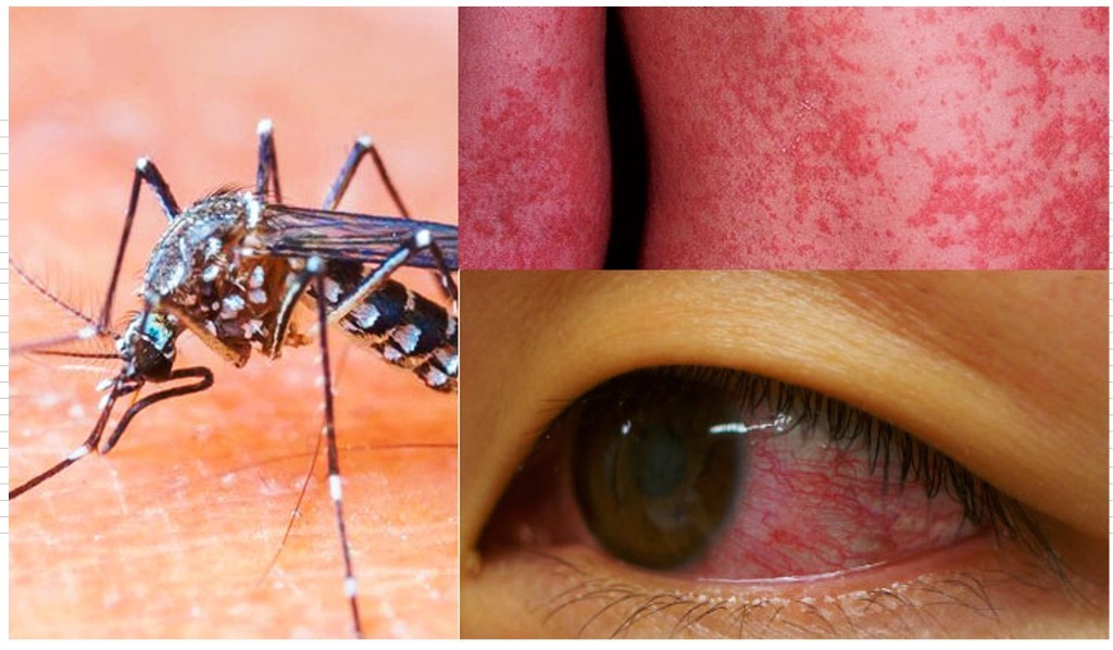 Confirman casos de Zika en México Confirman casos de Zika en México
