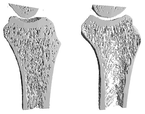 Osteoporosis un mal prevenible según el IMSS Osteoporosis un mal prevenible según el IMSS