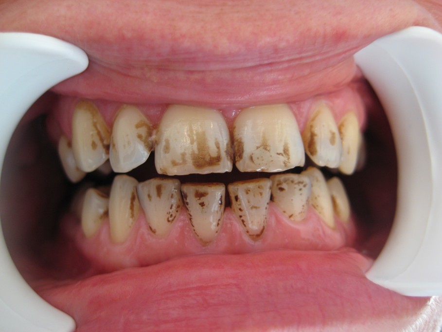 Dientes manchados, otro efecto negativo del tabaquismo Dientes manchados, otro efecto negativo del tabaquismo