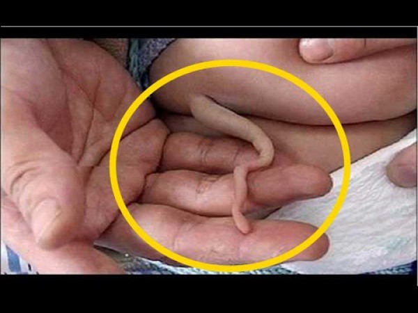 Bebé chino nació con una cola Bebé chino nació con una cola