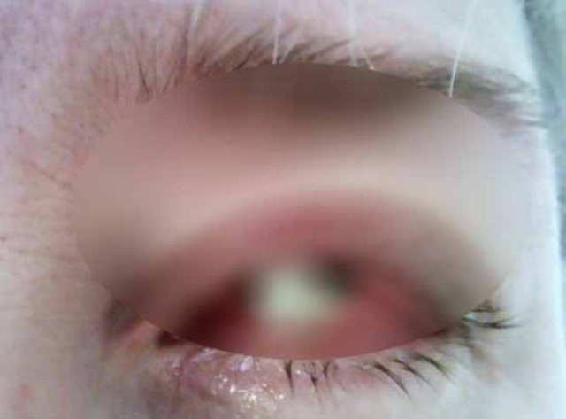 Niño de 12 años podría perder el ojo Niño de 12 años podría perder el ojo