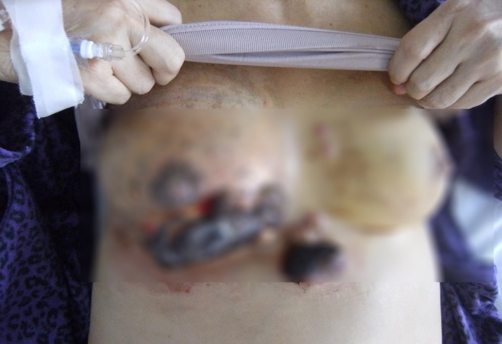 Cáncer de mama, principal causa de muerte en las mujeres Cáncer de mama, principal causa de muerte en las mujeres
