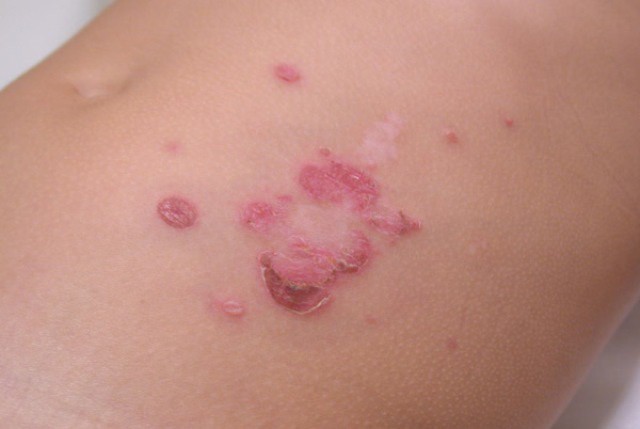 Más de 40 casos de mal de Chagas en Yucatán Más de 40 casos de mal de Chagas en Yucatán