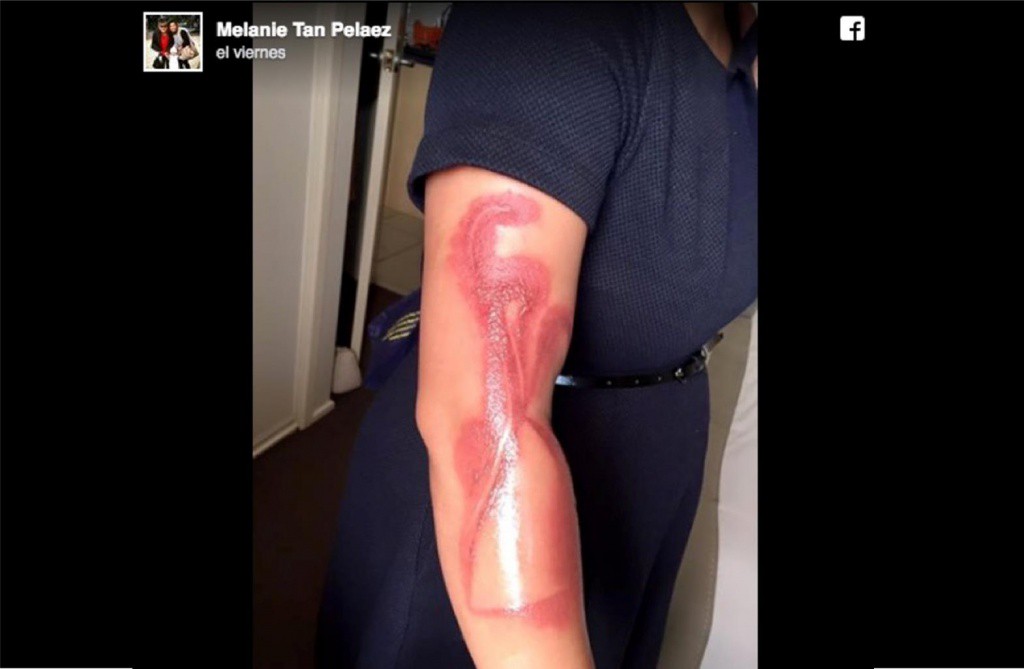 Se durmió sobre su celular y se quemó el brazo Se durmió sobre su celular y se quemó el brazo