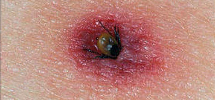 Rickettsia, una enfermedad mortal Rickettsia, una enfermedad mortal