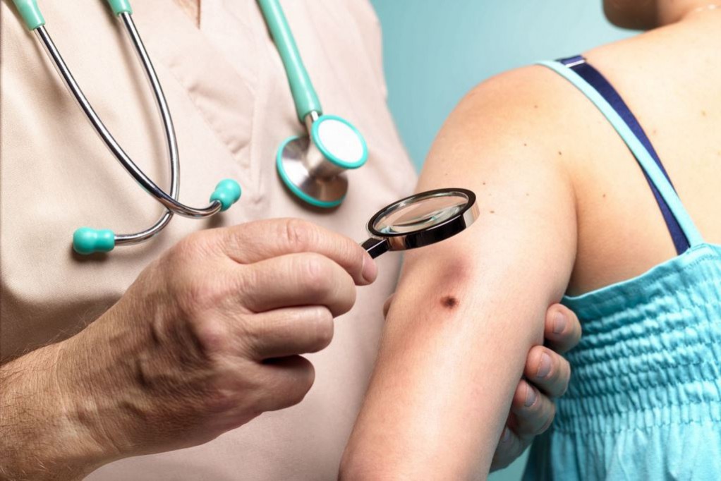 Incrementan casos de cáncer de piel en Yucatán Incrementan casos de cáncer de piel en Yucatán