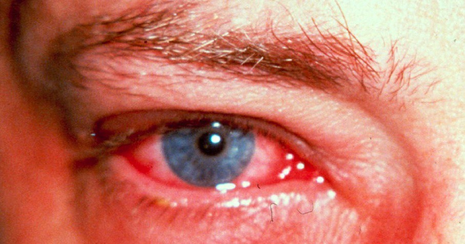 Se duplican casos de conjuntivitis en el oriente Se duplican casos de conjuntivitis en el oriente