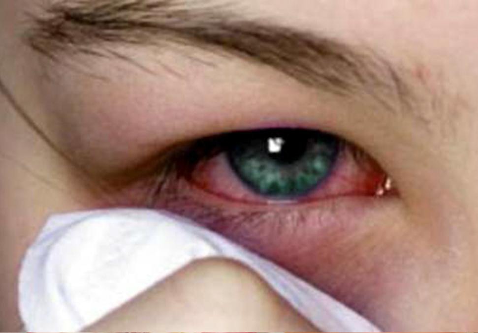 No existe vacuna contra la Conjuntivitis No existe vacuna contra la Conjuntivitis