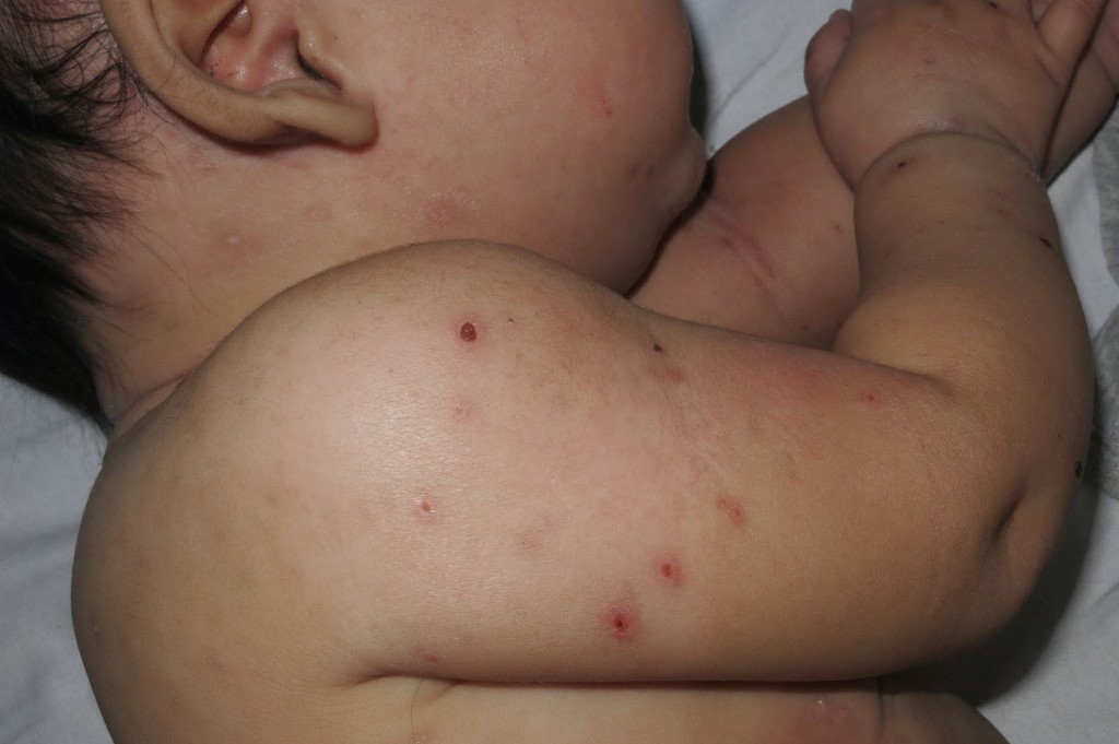 Aumentan los casos de varicela en Yucatán Aumentan los casos de varicela en Yucatán