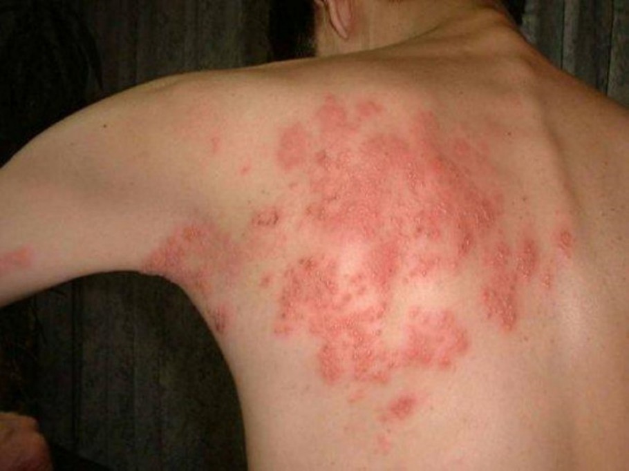 ¿Qué es el Herpes Zóster? ¿Qué es el Herpes Zóster?