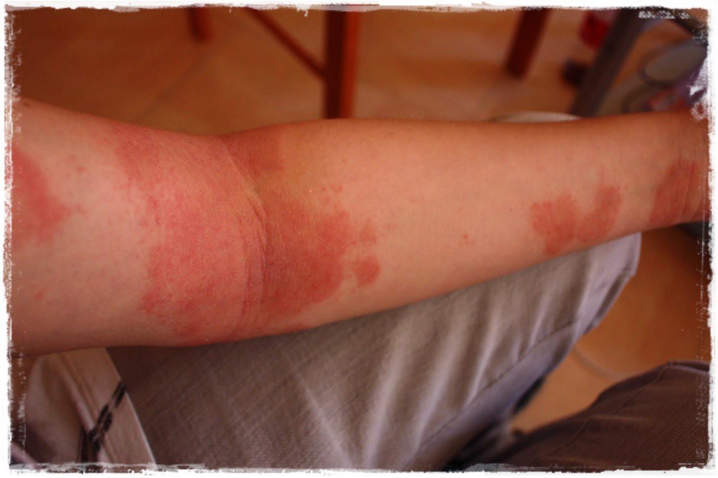 La voz del paciente con Dermatitis Atópica La voz del paciente con Dermatitis Atópica