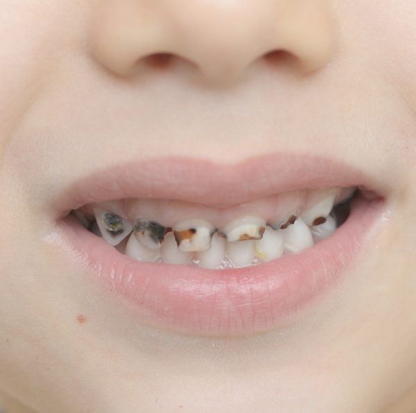 Las caries, principal padecimiento en infantes Las caries, principal padecimiento en infantes