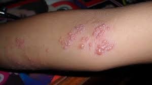 Estrés puede ocasionar Herpes Zoster Estrés puede ocasionar Herpes Zoster