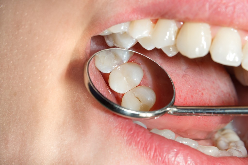 El 95% de los mexicanos padece de caries. El 95% de los mexicanos padece de caries.