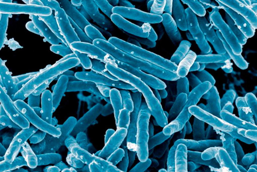 En México ya hay 2375 casos reportados de tuberculosis este 2021. En México ya hay 2375 casos reportados de tuberculosis este 2021.