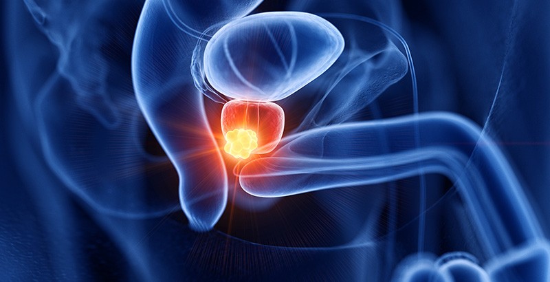 Cáncer de próstata, segunda causa de muerte en hombres Cáncer de próstata, segunda causa de muerte en hombres