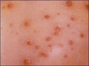 La Varicela, enfermedad altamente contagiosa La Varicela, enfermedad altamente contagiosa