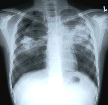 Se diagnostican 180 casos de tuberculosis pulmonar al año en Yucatán Se diagnostican 180 casos de tuberculosis pulmonar al año en Yucatán