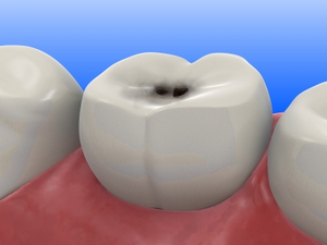 El 70% de los niños de Mérida y comisarías, con problemas de caries El 70% de los niños de Mérida y comisarías, con problemas de caries