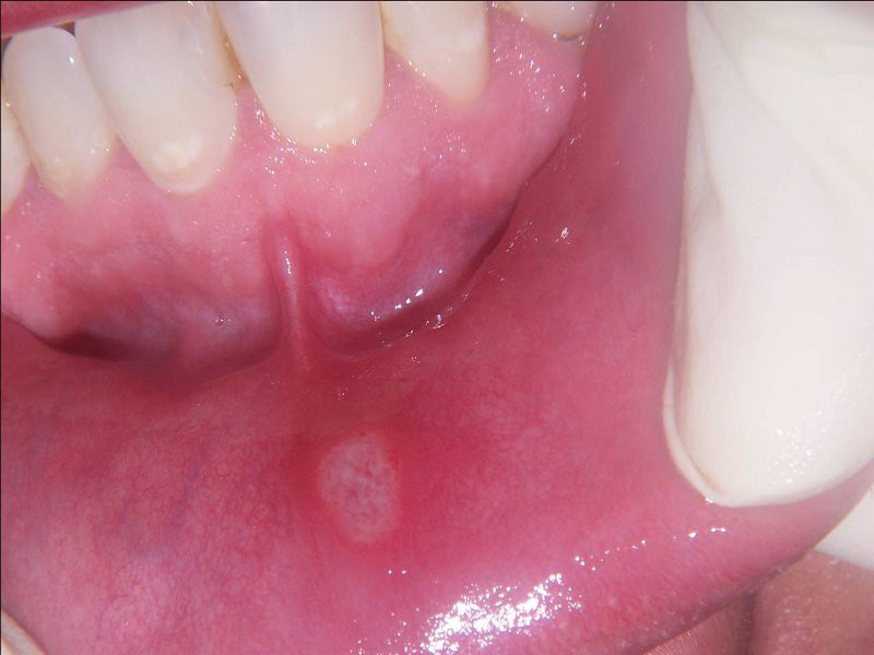 Aftas bucales, pequeñas lesiones que afecta la cavidad oral Aftas bucales, pequeñas lesiones que afecta la cavidad oral