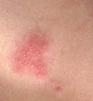 Herpes Zóster un riesgo para quienes ya padecieron varicela Herpes Zóster un riesgo para quienes ya padecieron varicela