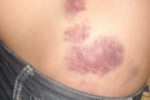Alerta IMSS Yucatán sobre los síntomas de púrpura Alerta IMSS Yucatán sobre los síntomas de púrpura